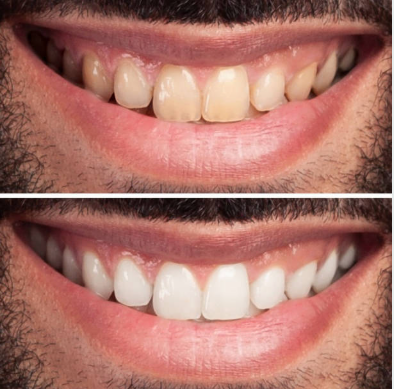 “I drink coffee every day, so my teeth always look yellowish. This pen really helped brighten my smile. No pain, no burning. Just results.”
